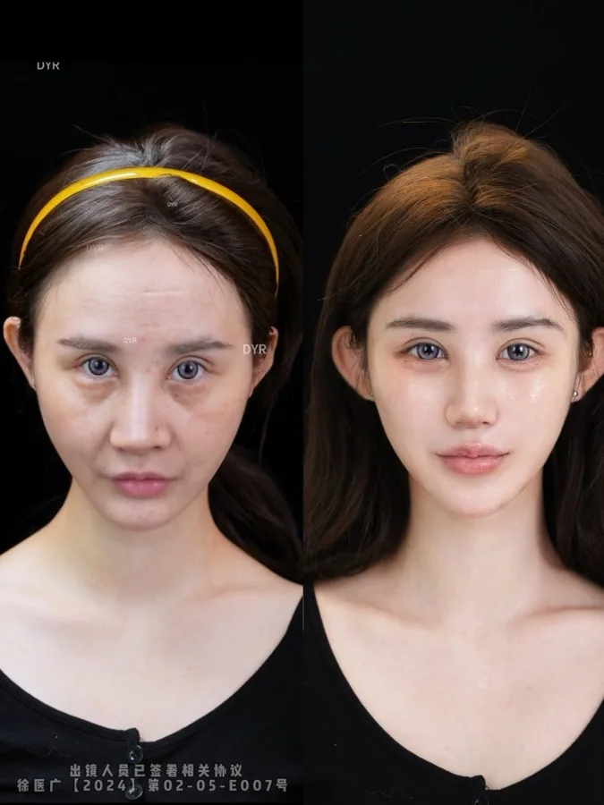 Historical facial lifting and Baby Face case 09