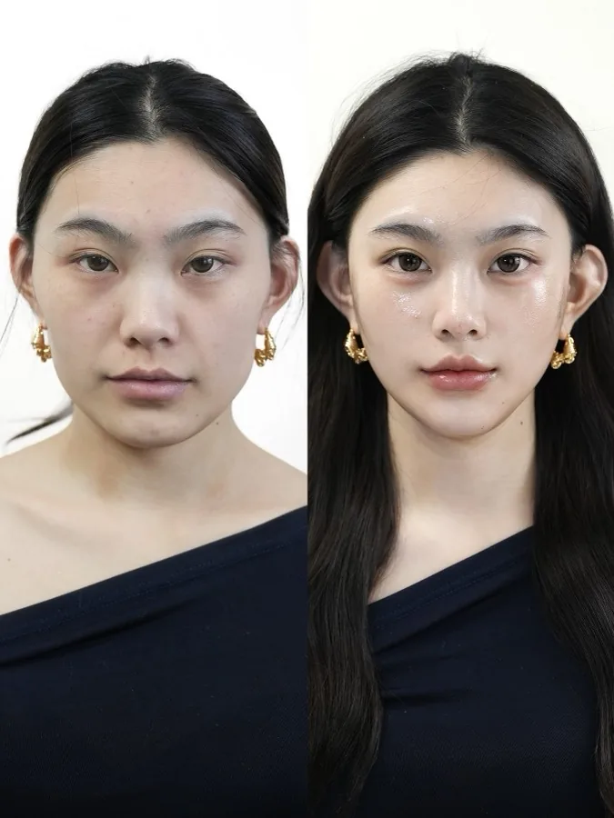 Historical facial lifting and Baby Face case 02