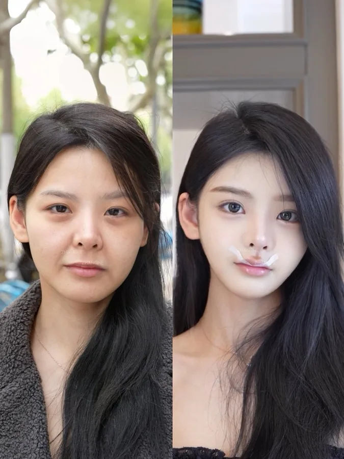 Historical facial lifting and Baby Face case 12