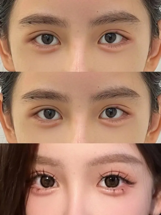 Historical facial lifting and Baby Face case 07